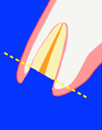 エクストリュージョン法