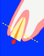 エクストリュージョン法