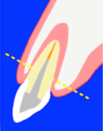 エクストリュージョン法