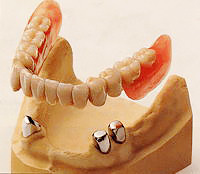 残っている歯を大事にするなら「コーヌスクローネ義歯」
