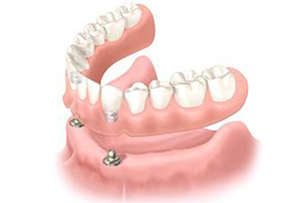 総入れ歯を完全に固定する「インプラントオーバーデンチャー」
