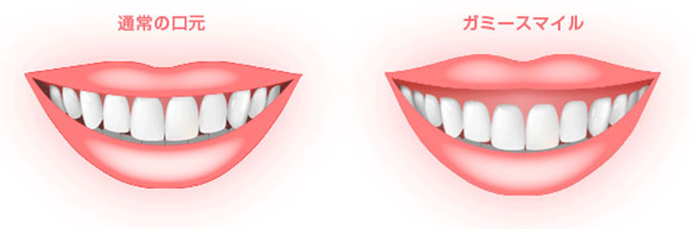 笑うと歯茎が見える「ガミースマイル」の改善も可能
