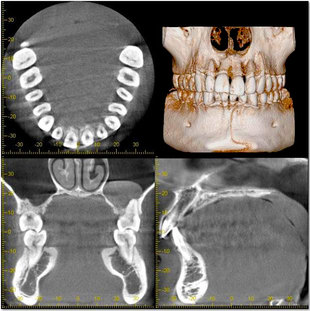 顎の構造を3次元的に把握する「CT診断」