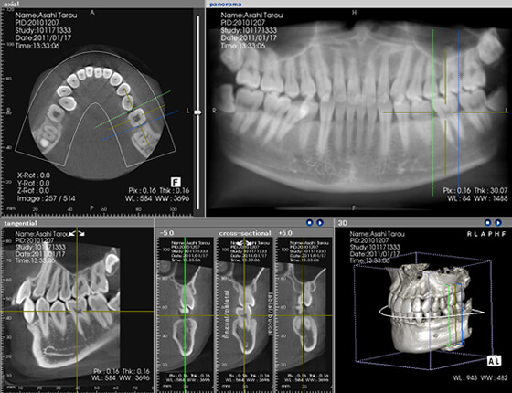 CT検査で顎の骨の状態を確認