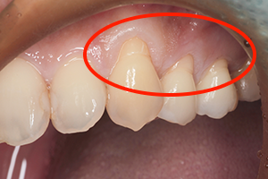 治療後の見た目を改善する「歯肉移植手術」
